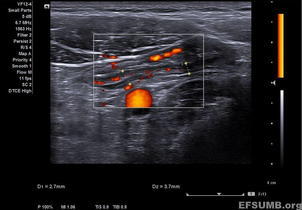 Ulcerative colitis [1 image]