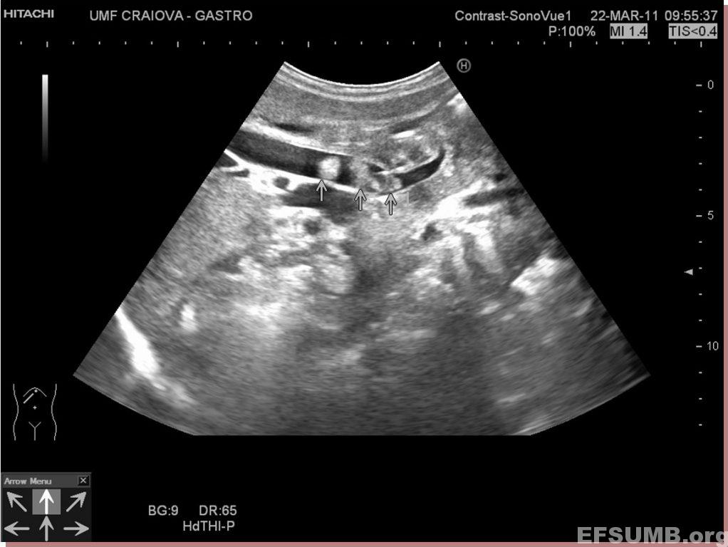 Choledocholithiasis [1 image]